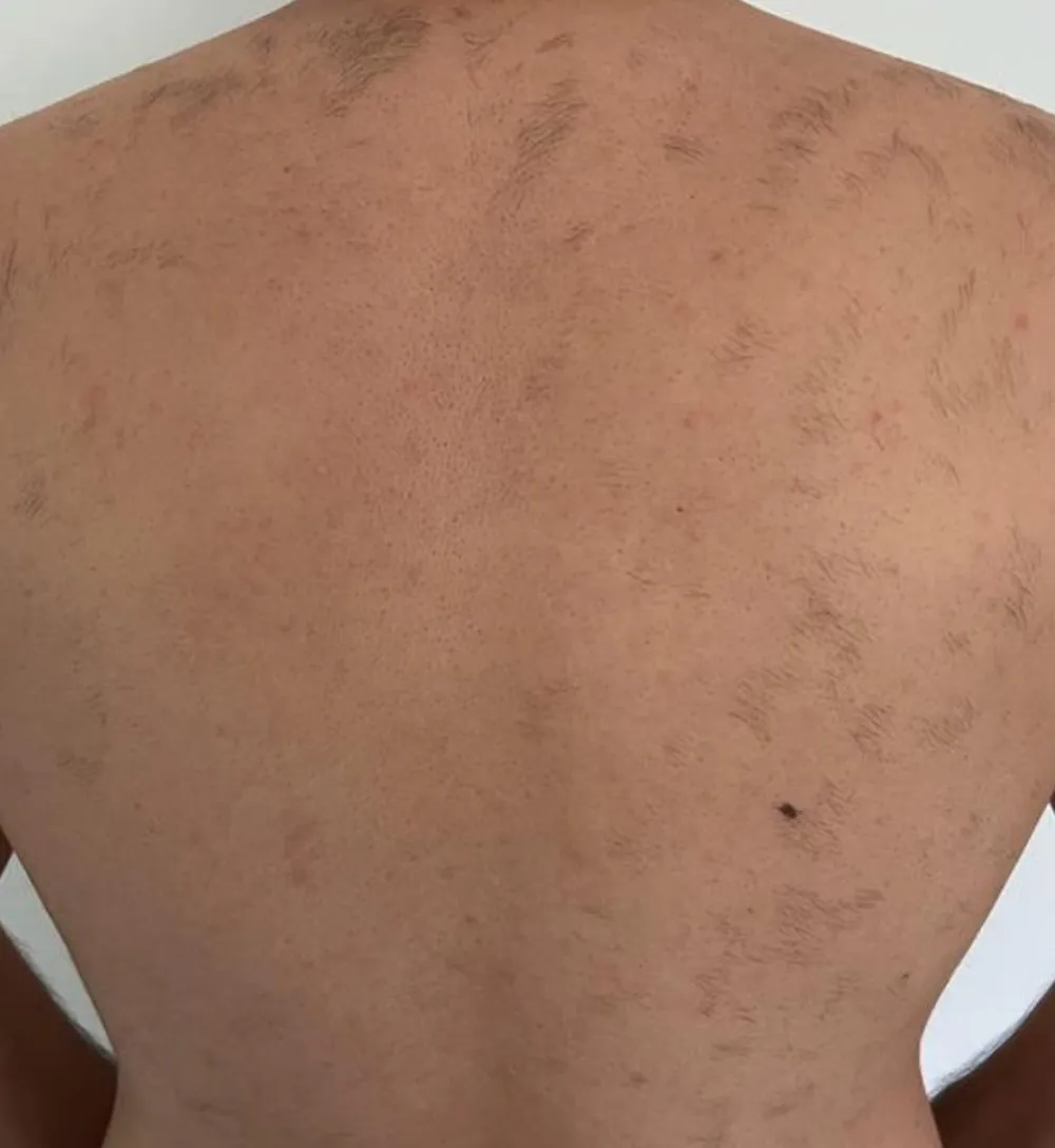 Rücken eines Kunden nach der Laser-Haarentfernung — nur noch vereinzelte Haare
